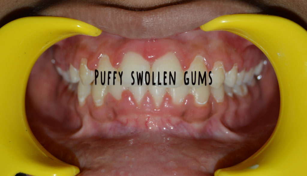 Early Signs Of Gum Disease Dt Smile Care